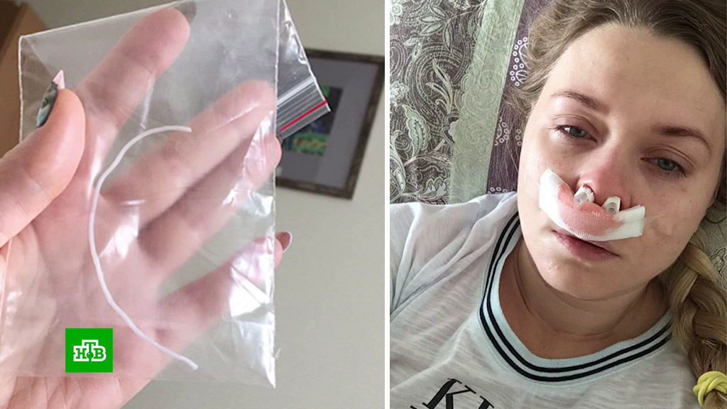 У россиянки сгнили зубы из-за забытого врачом катетера